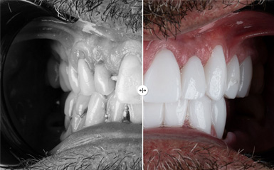 Before After -2